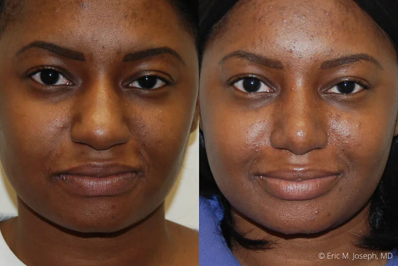 Rhinoplasty-0301.jpg