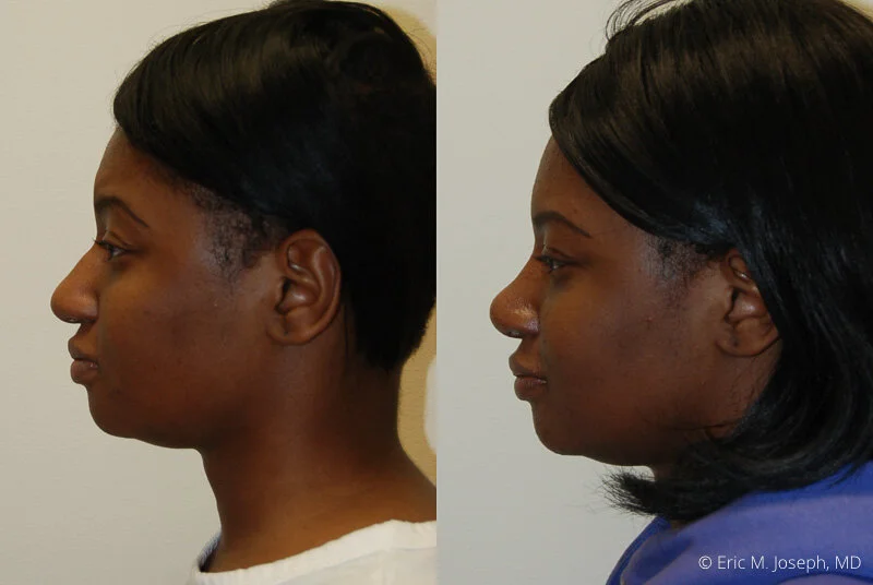 Rhinoplasty-0302.jpg