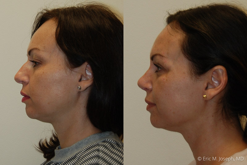 Rhinoplasty-0303.jpg