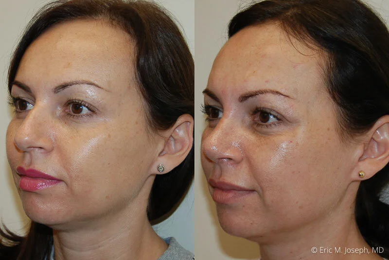 Rhinoplasty-0304.jpg