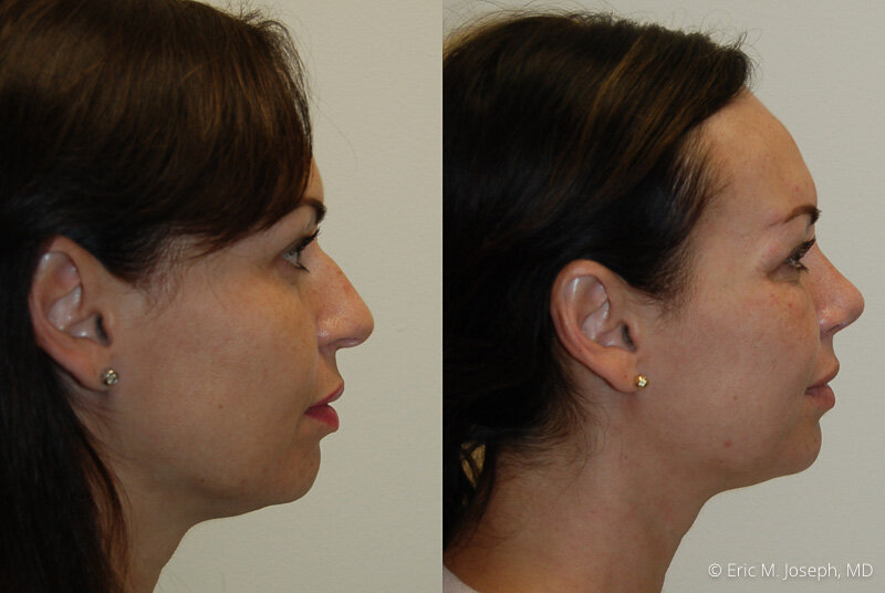 Rhinoplasty-0307.jpg