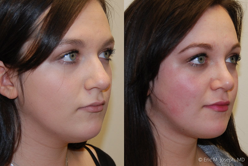 Rhinoplasty-0309.jpg