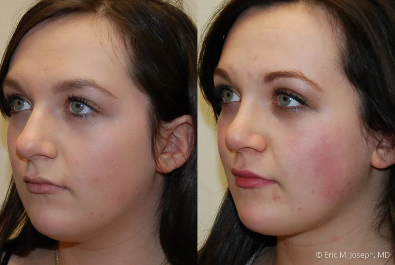 Rhinoplasty-0308.jpg