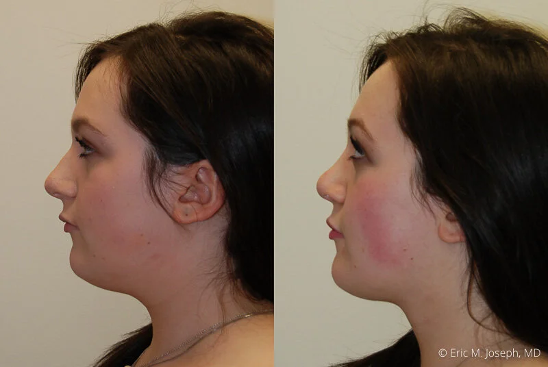 Rhinoplasty-0311.jpg