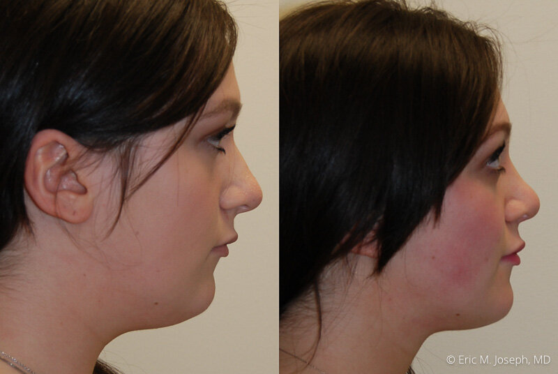 Rhinoplasty-0312.jpg