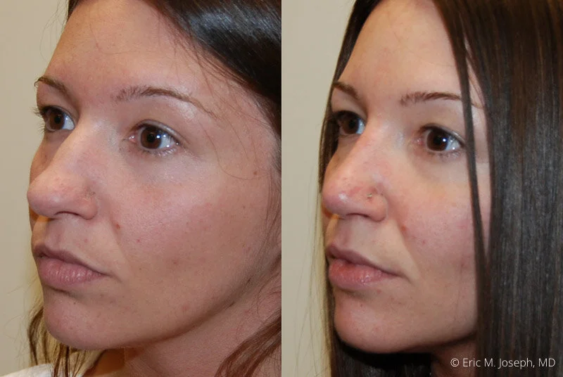 Rhinoplasty-0313.jpg