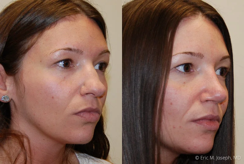 Rhinoplasty-0314.jpg