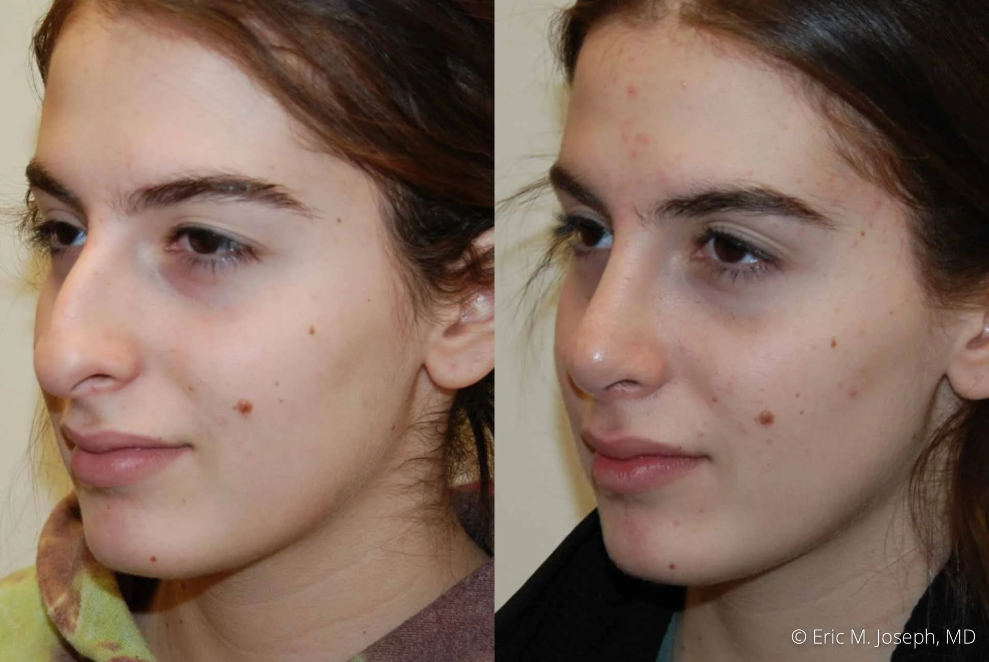 Rhinoplasty-0331.jpg