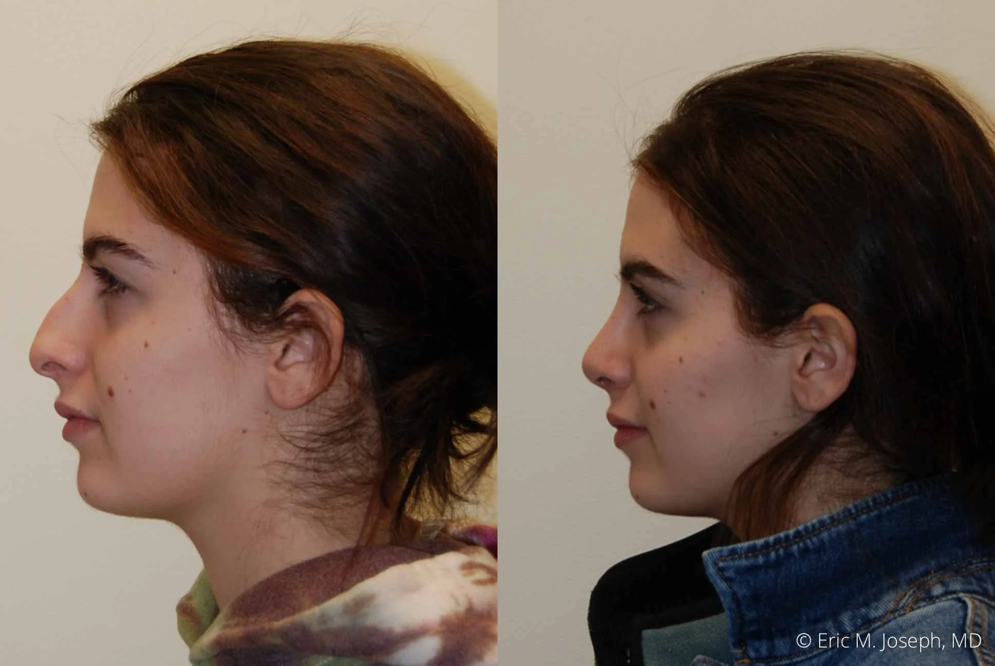 Rhinoplasty-0334.jpg