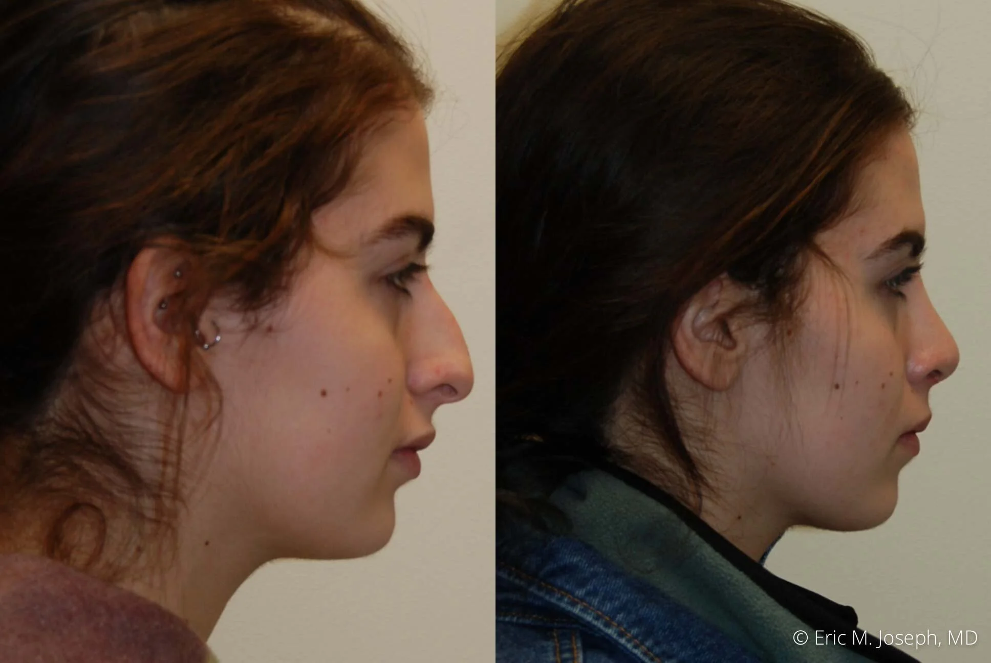Rhinoplasty-0335.jpg