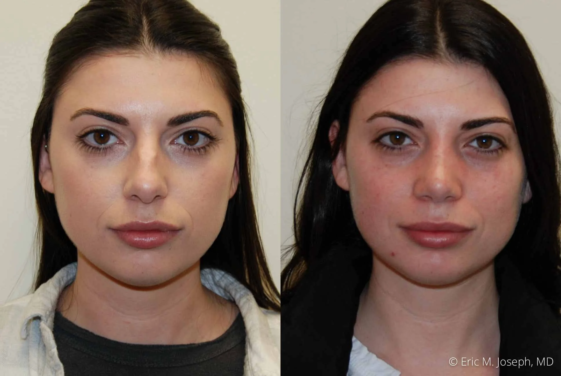 Rhinoplasty-0337.jpg