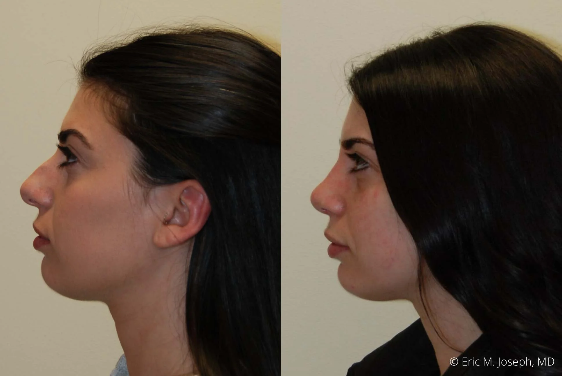 Rhinoplasty-0339.jpg
