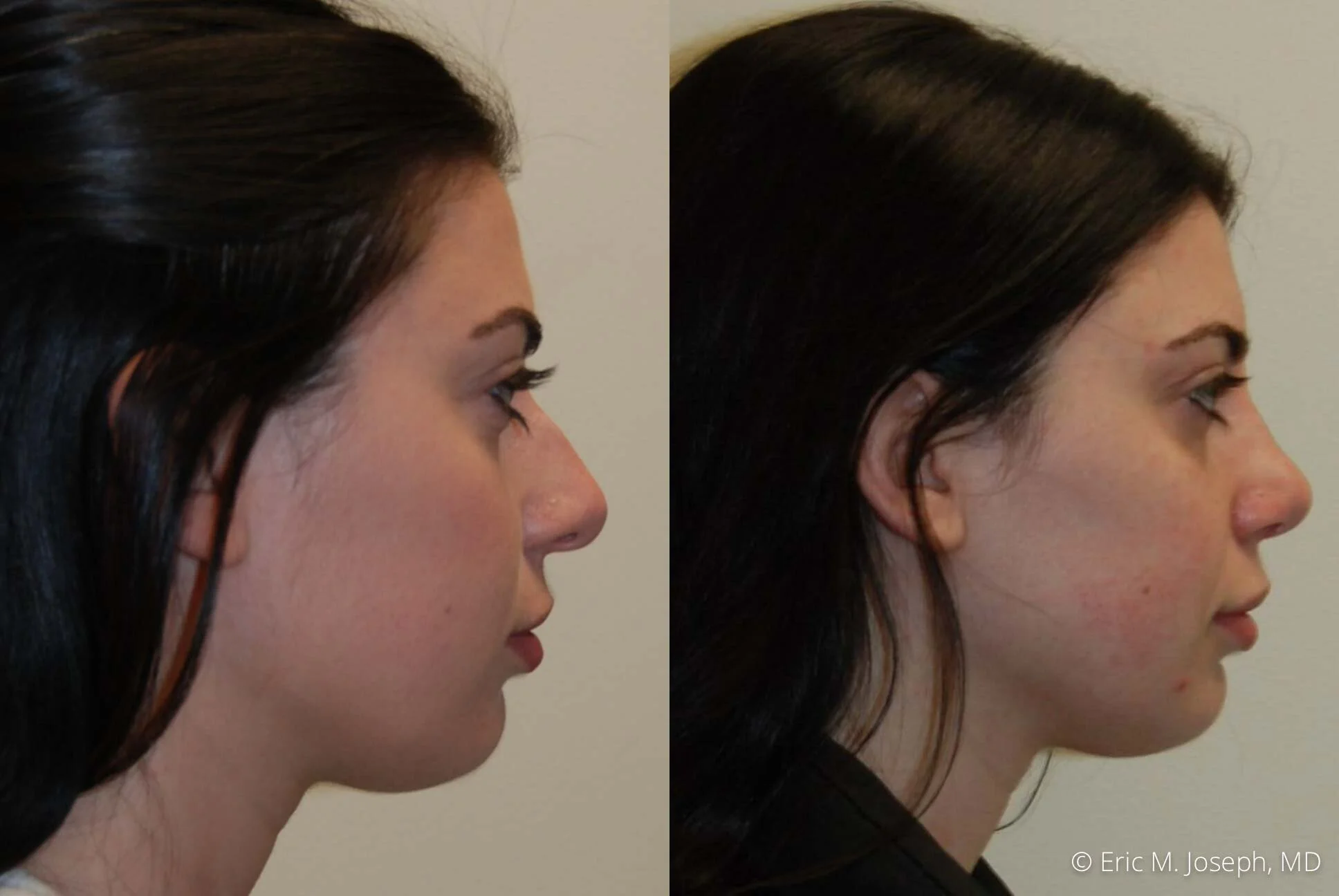 Rhinoplasty-0341.jpg