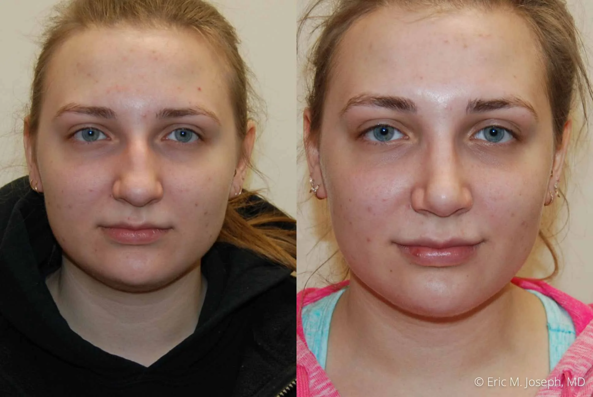 Rhinoplasty-0342.jpg