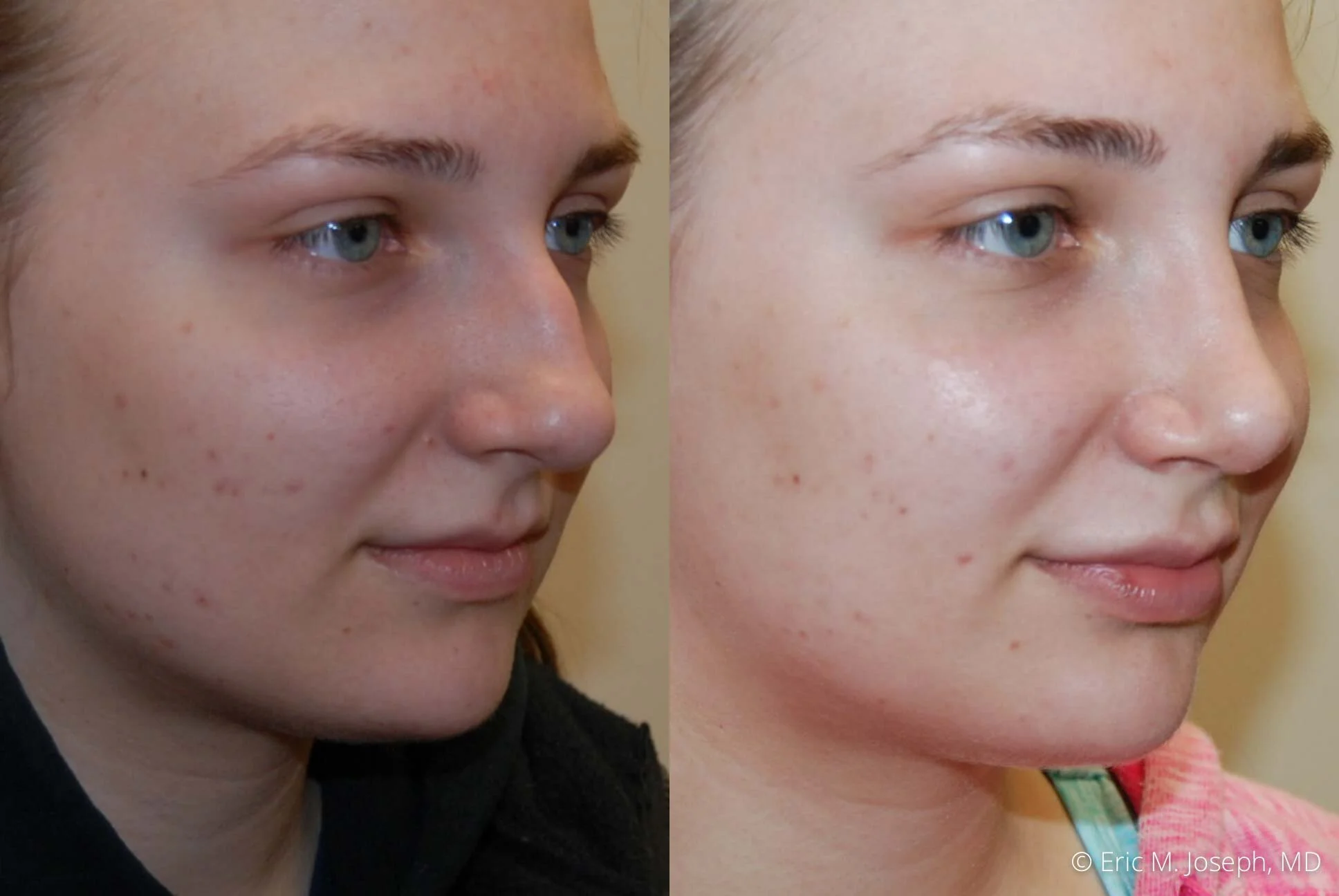 Rhinoplasty-0344.jpg