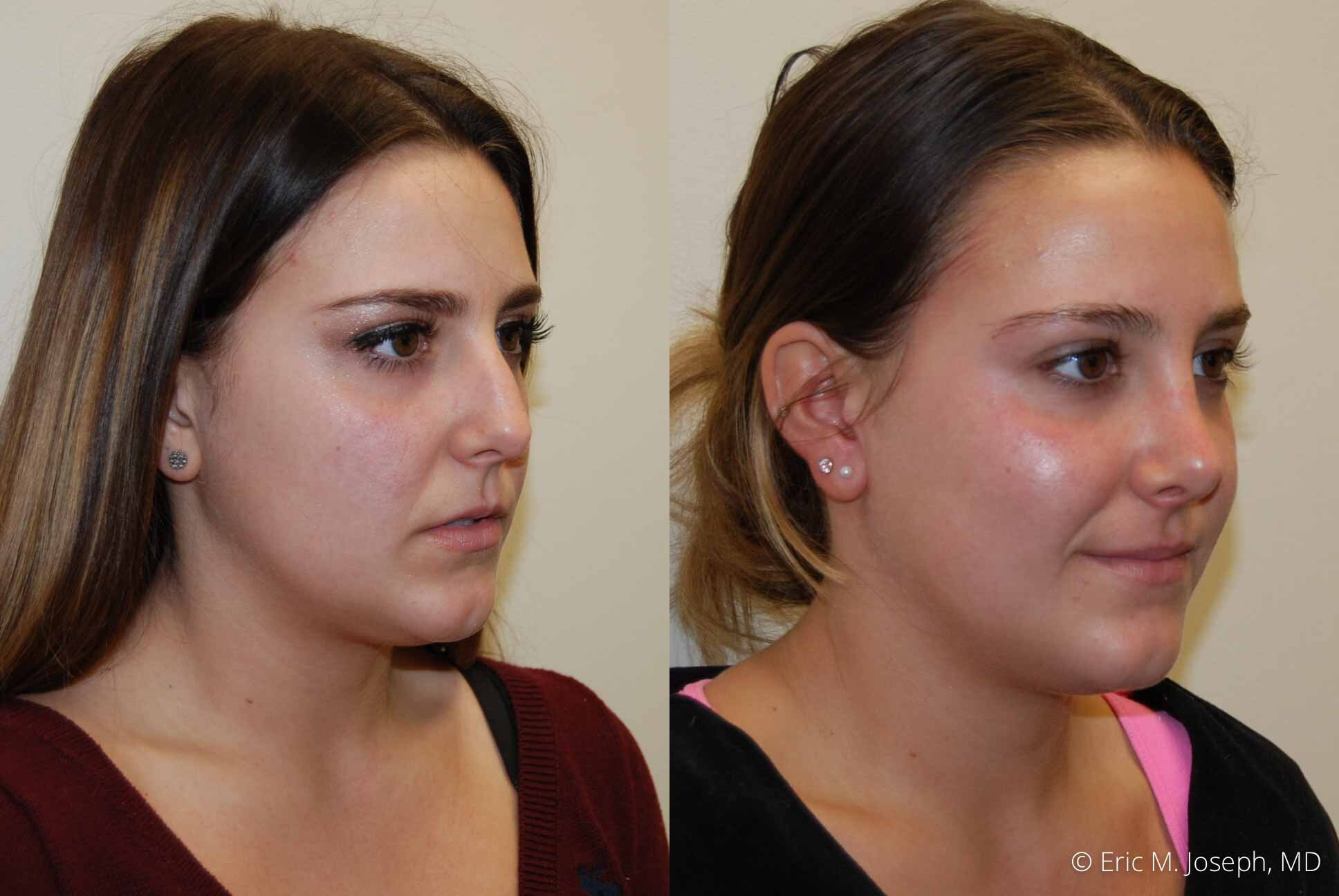 Rhinoplasty-0348.jpg