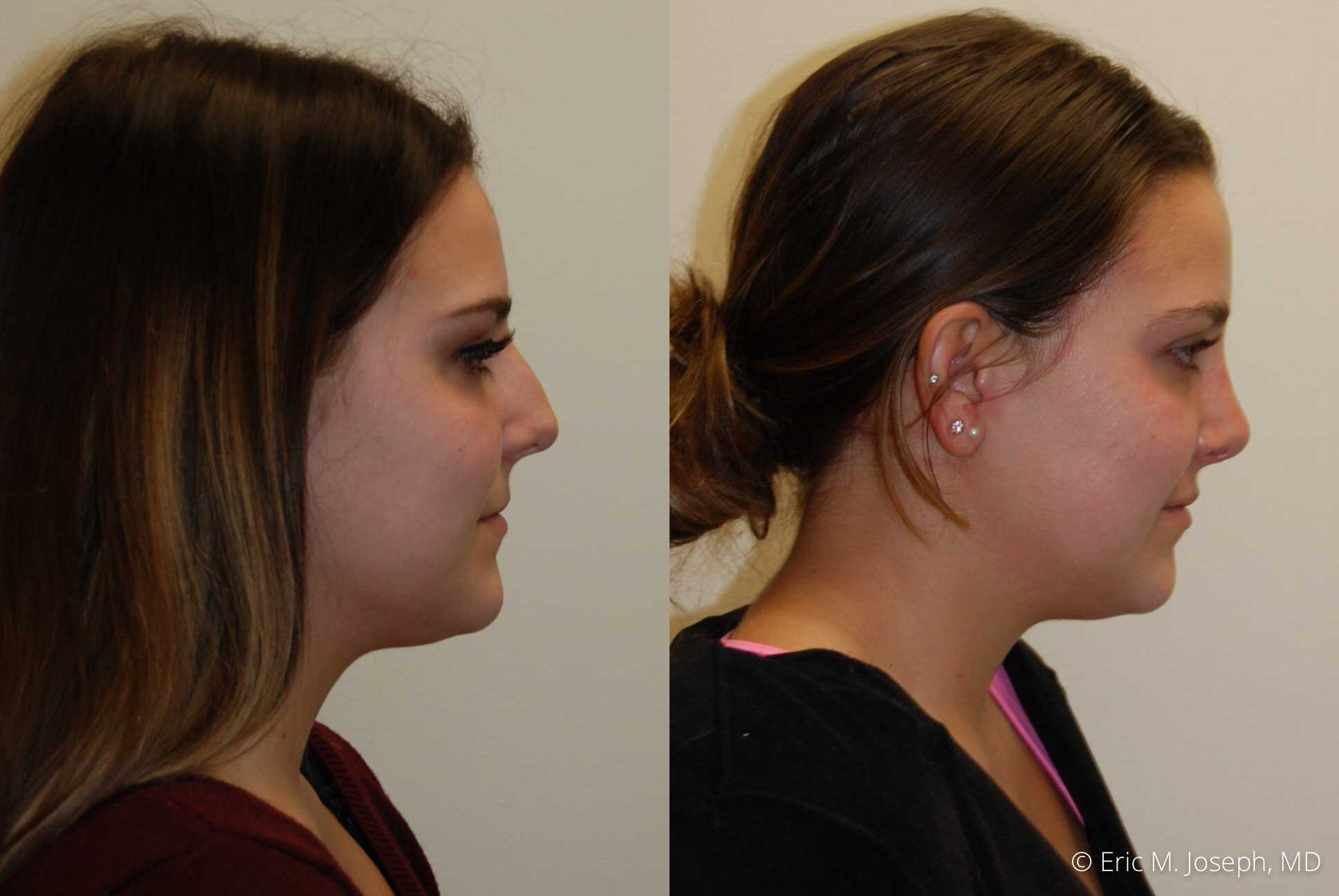 Rhinoplasty-0351.jpg