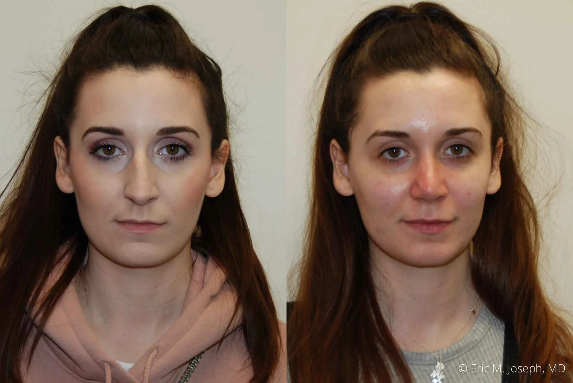 Rhinoplasty-0354.jpg