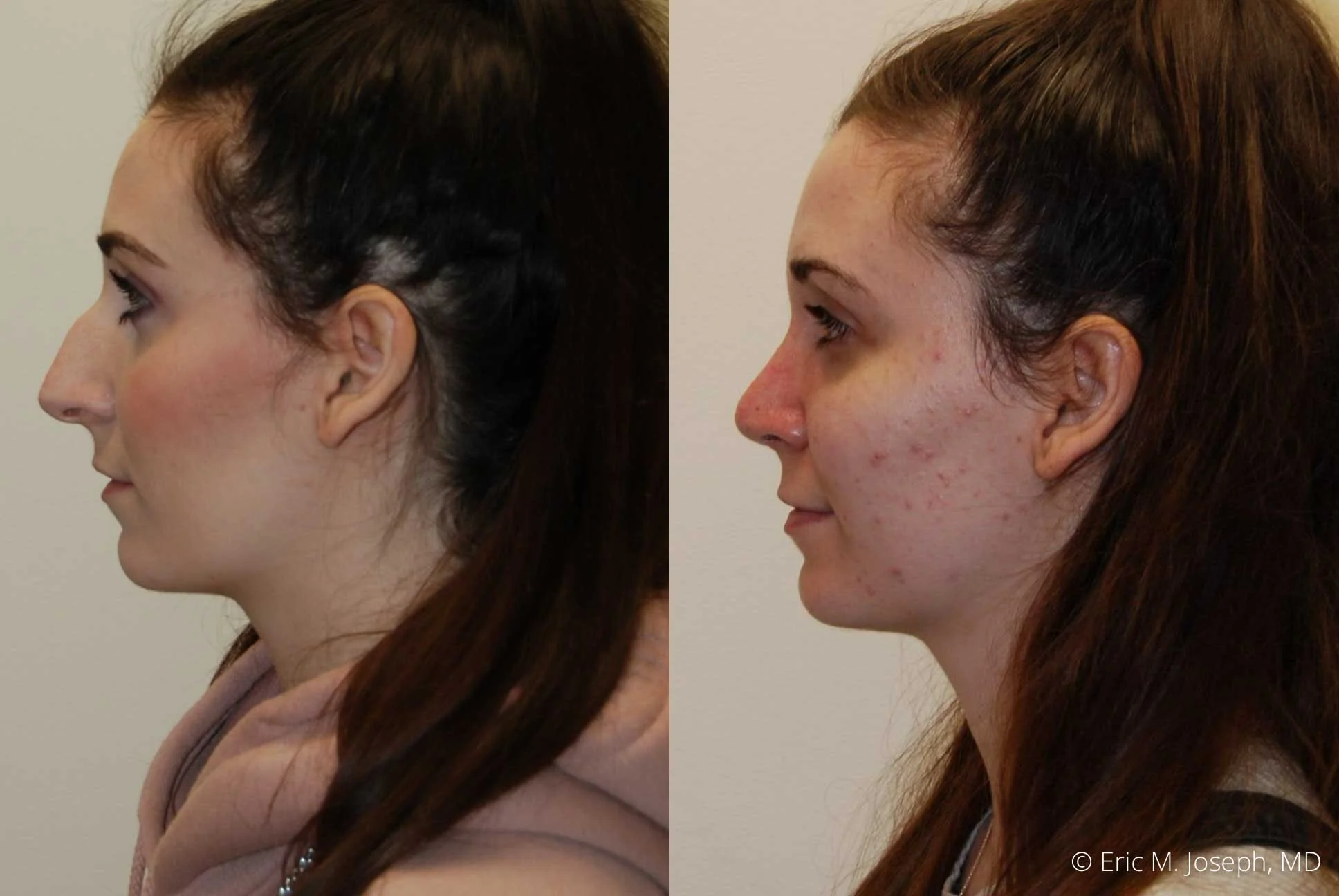Rhinoplasty-0355.jpg