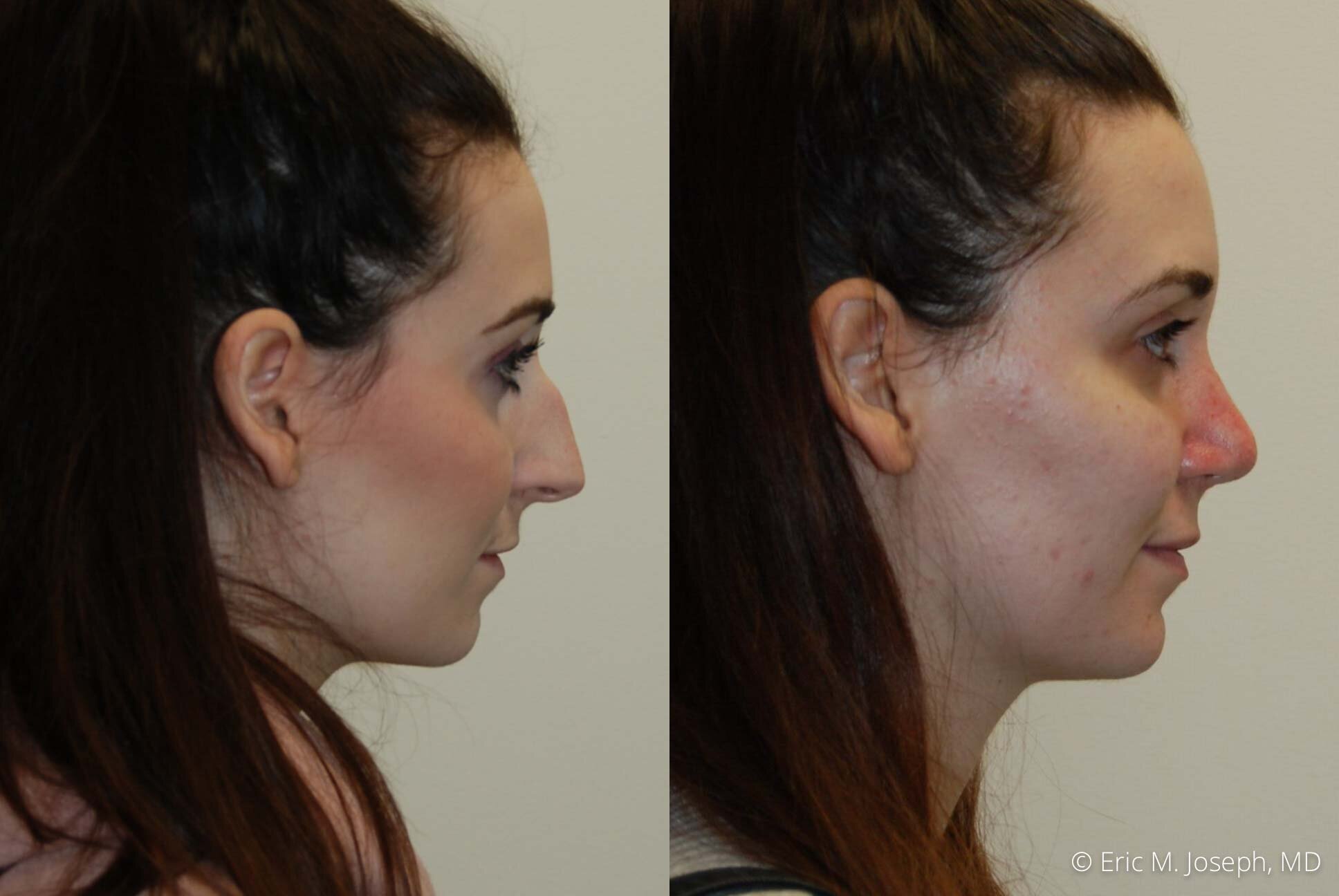 Rhinoplasty-0356.jpg