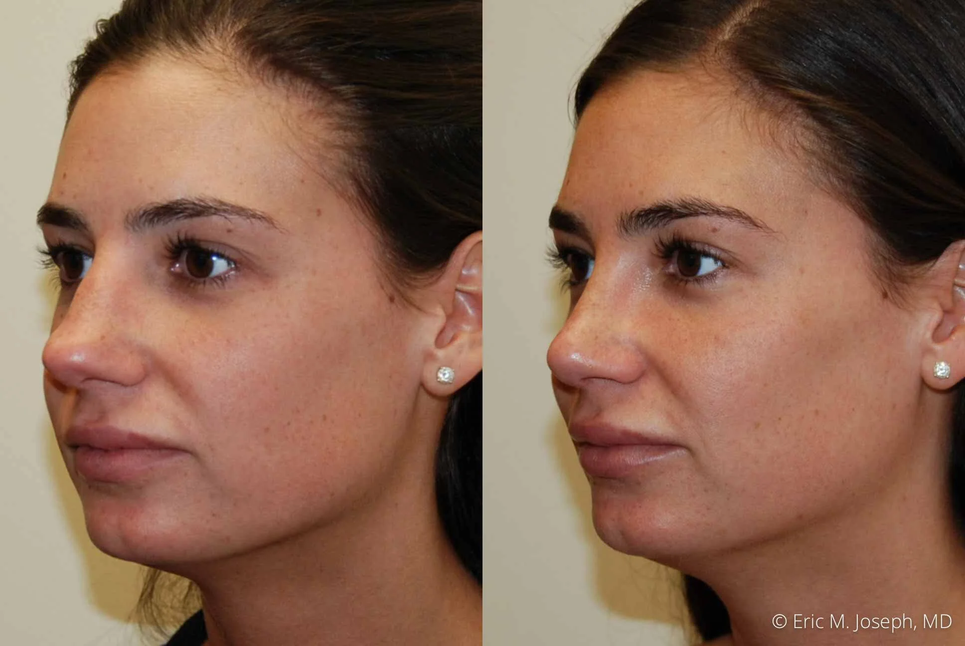 Rhinoplasty-0362.jpg