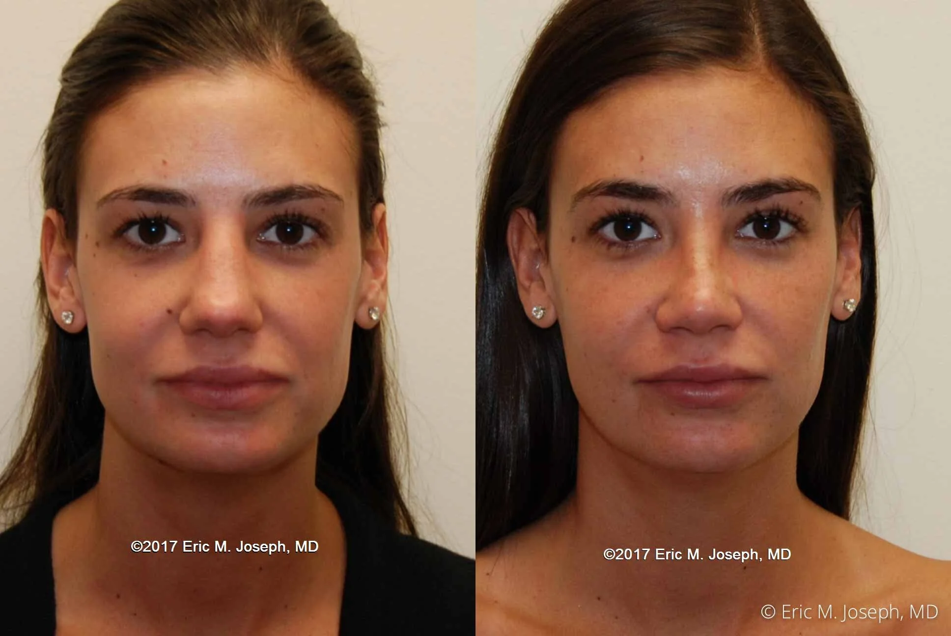 Rhinoplasty-0363.jpg