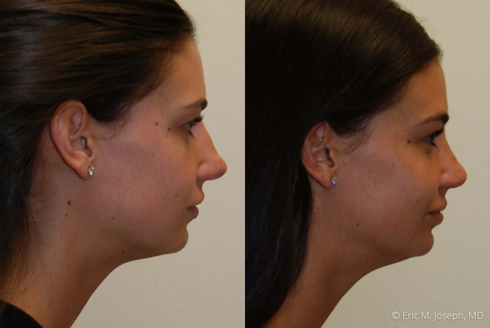 Rhinoplasty-0365.jpg