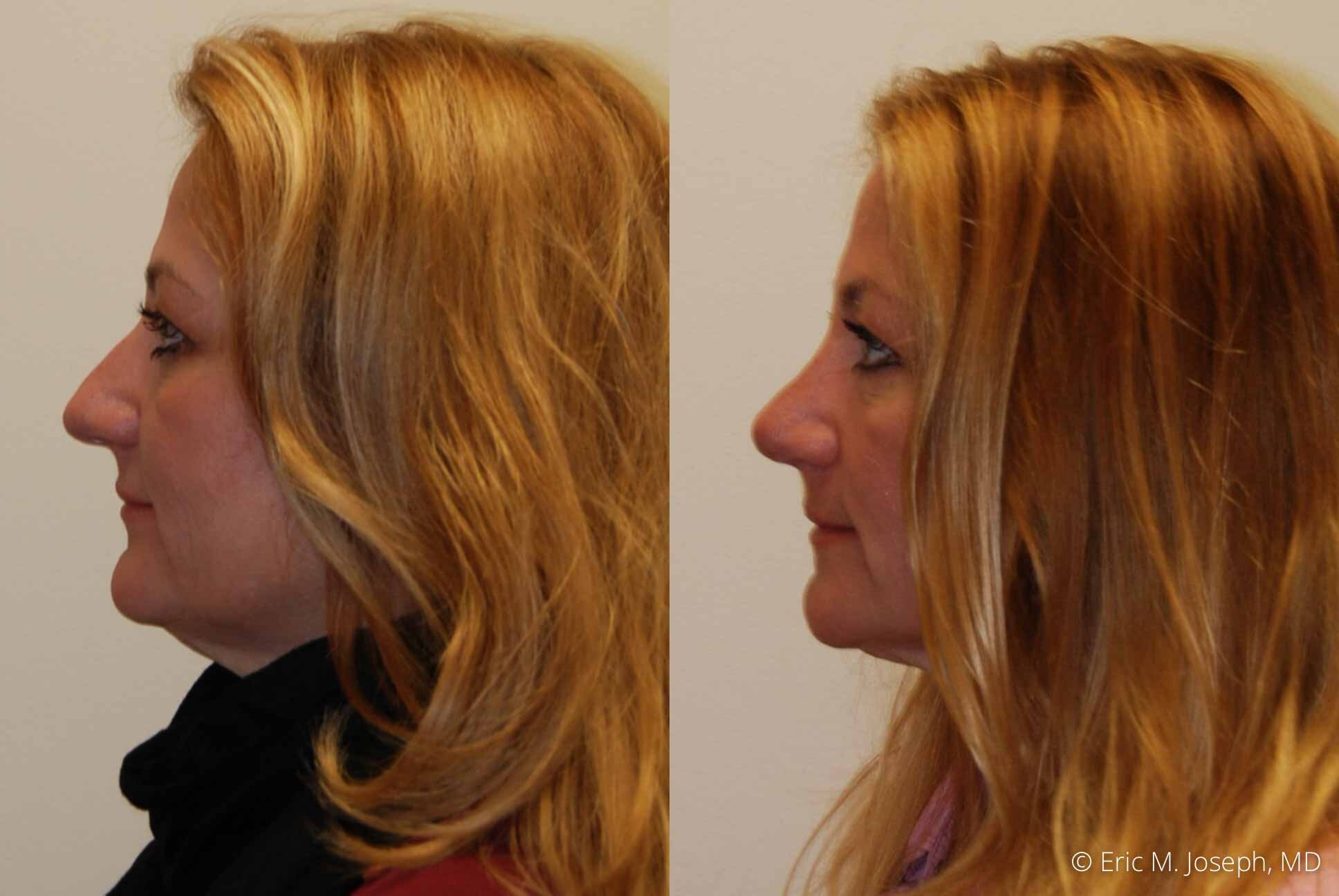Rhinoplasty-0368.jpg