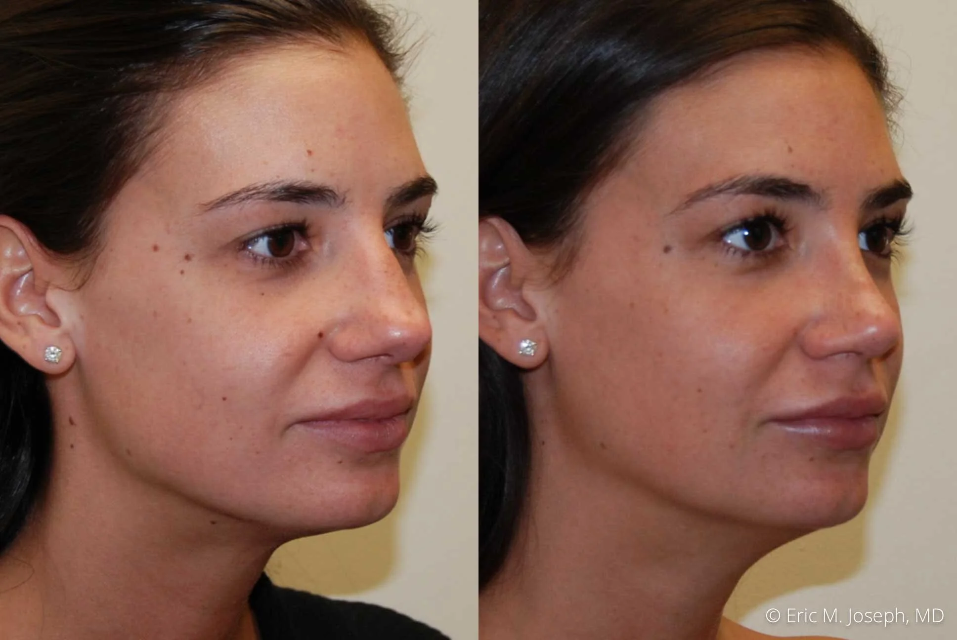 Rhinoplasty-0371.jpg