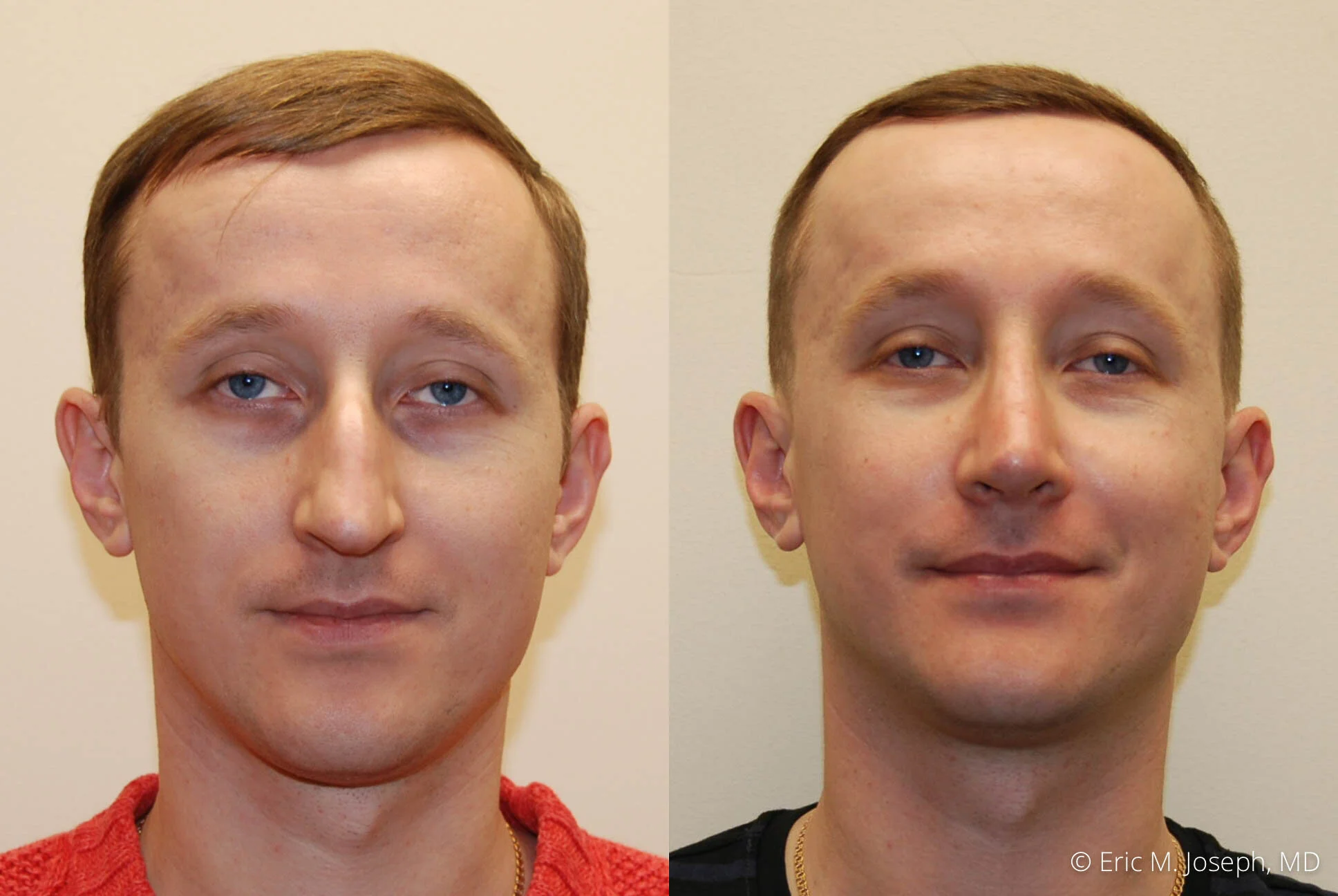 rhinoplasty-new-jersey-essex-bergan-nj-0412.jpg