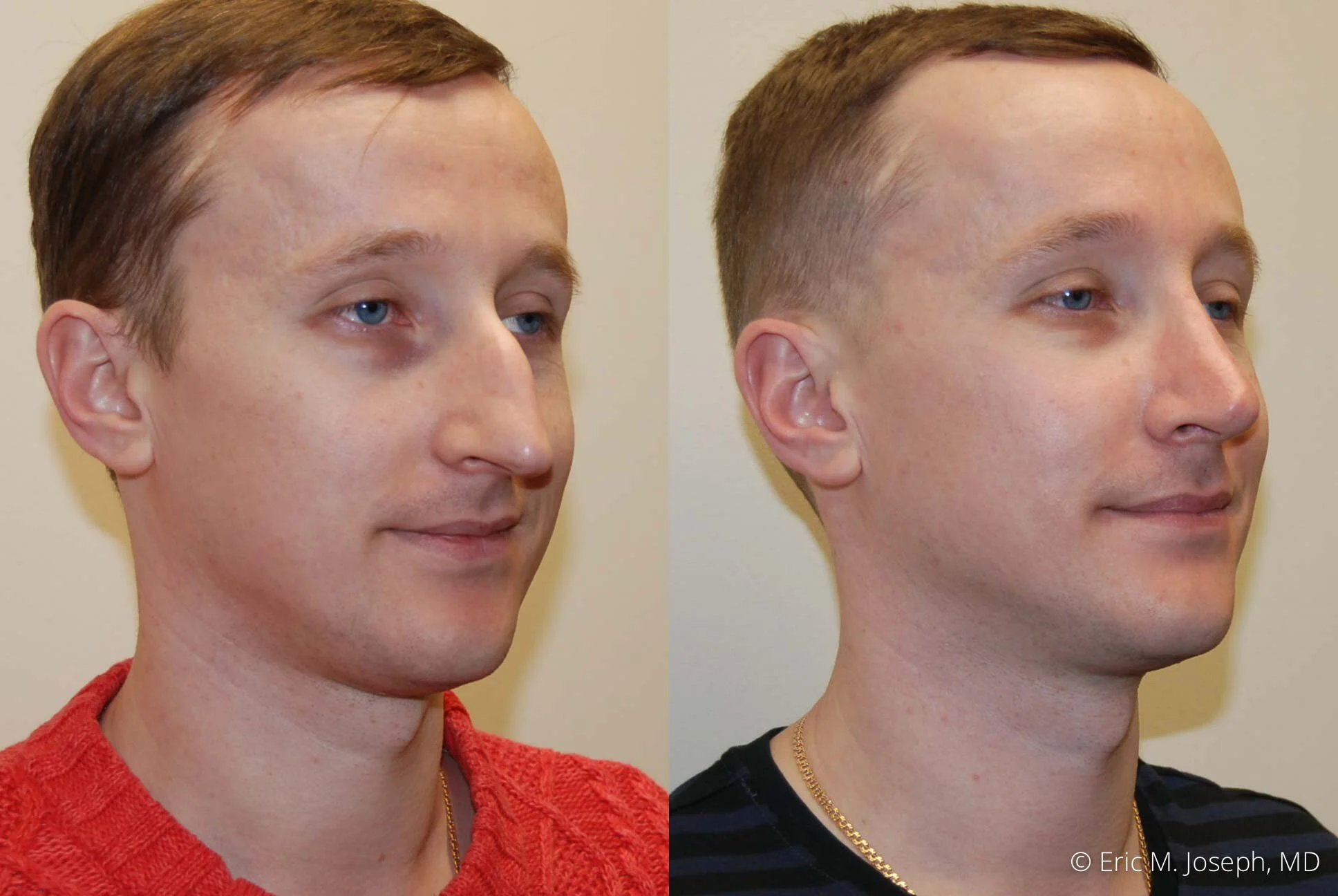 rhinoplasty-new-jersey-essex-bergan-nj-0413.jpg