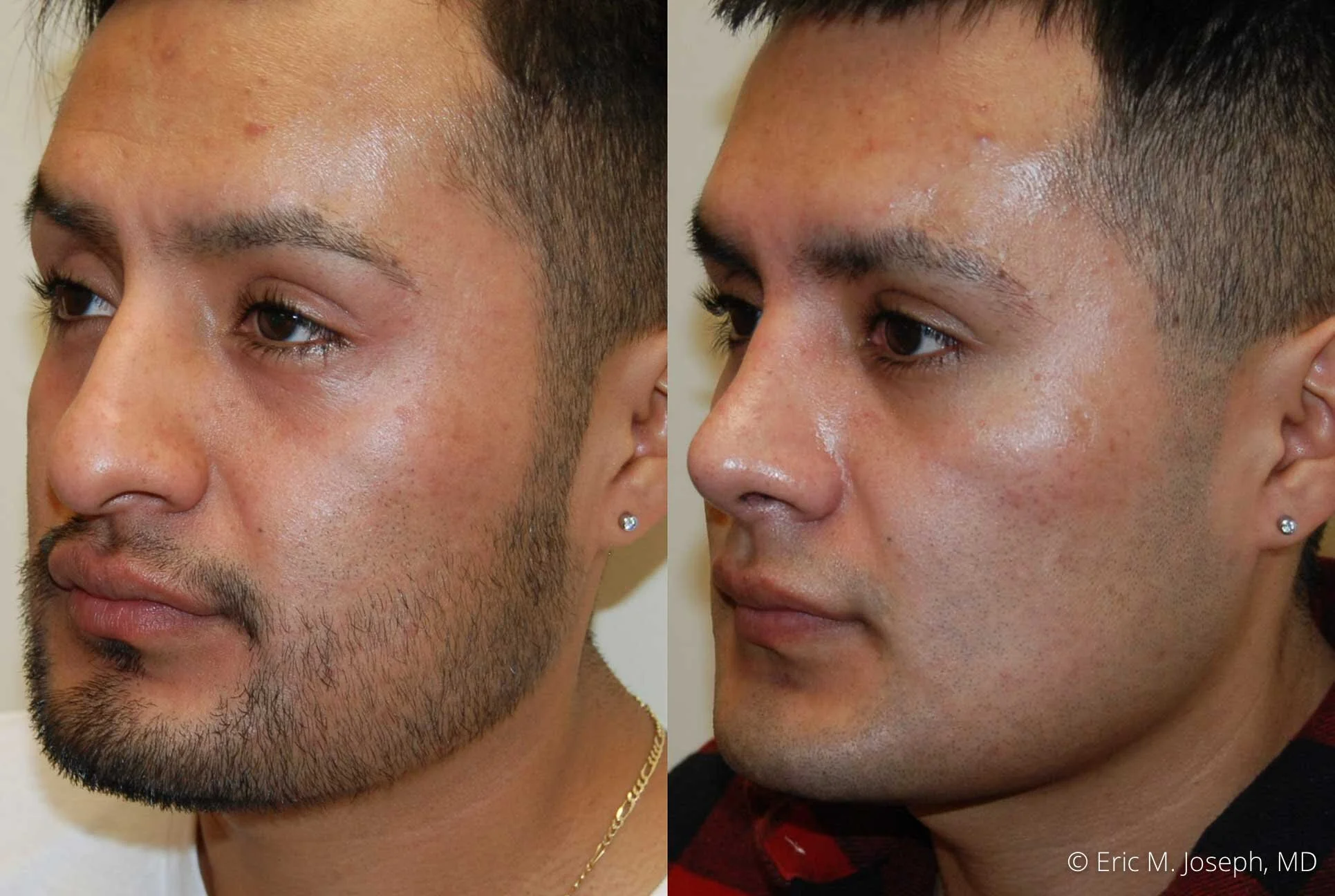rhinoplasty-new-jersey-essex-bergan-nj-0420.jpg