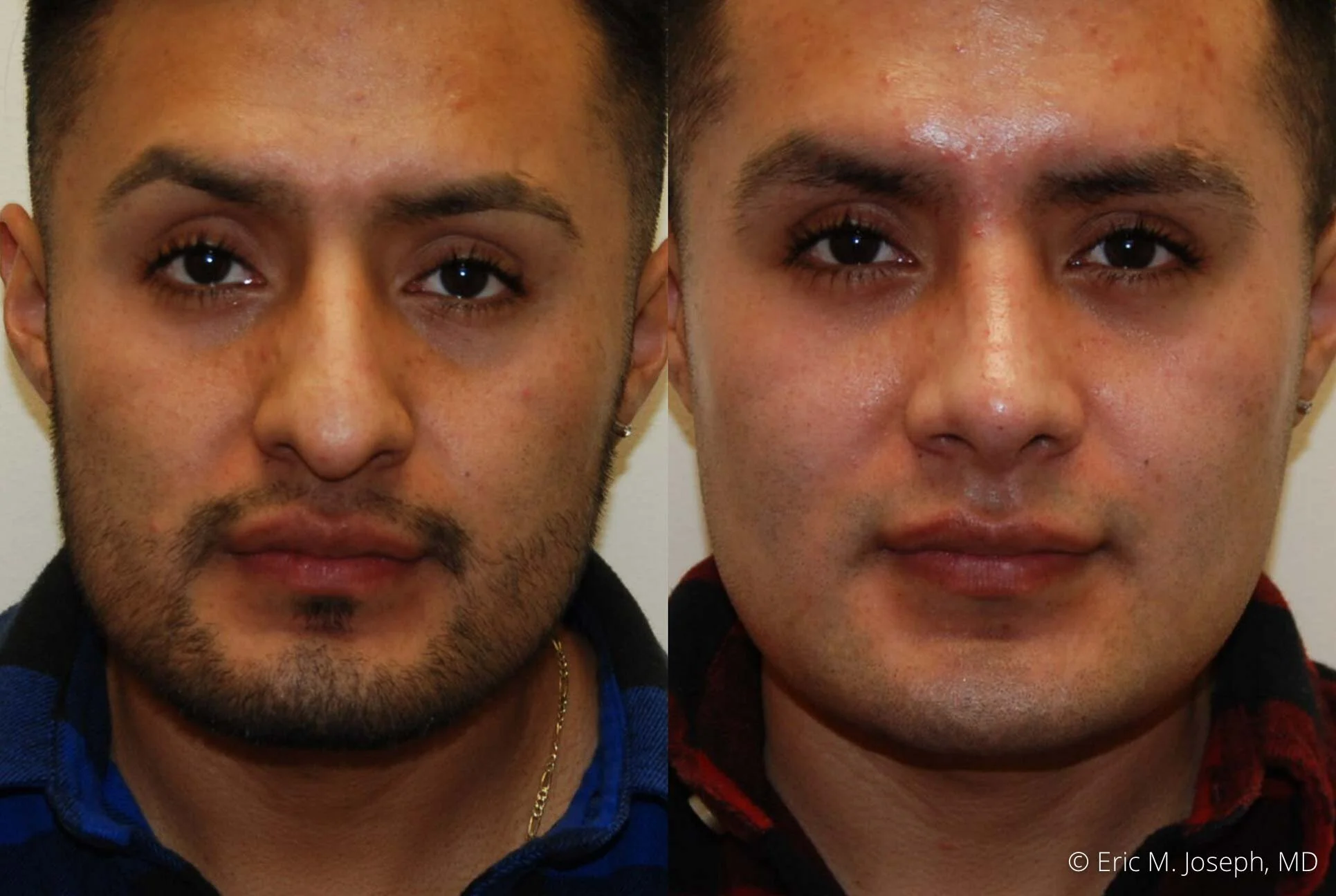 rhinoplasty-new-jersey-essex-bergan-nj-0421.jpg