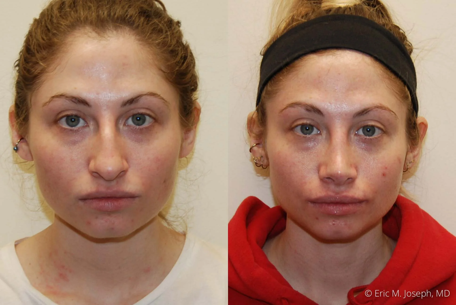 rhinoplasty-new-jersey-essex-bergan-nj-0427.jpg