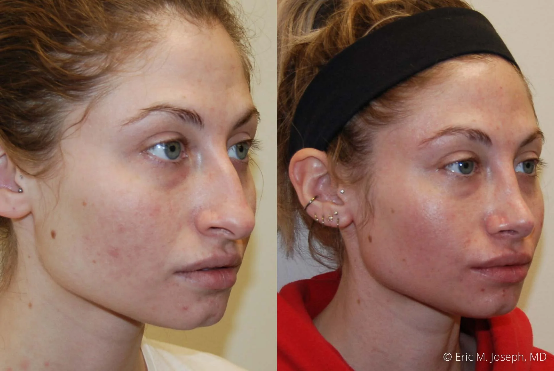 rhinoplasty-new-jersey-essex-bergan-nj-0428.jpg
