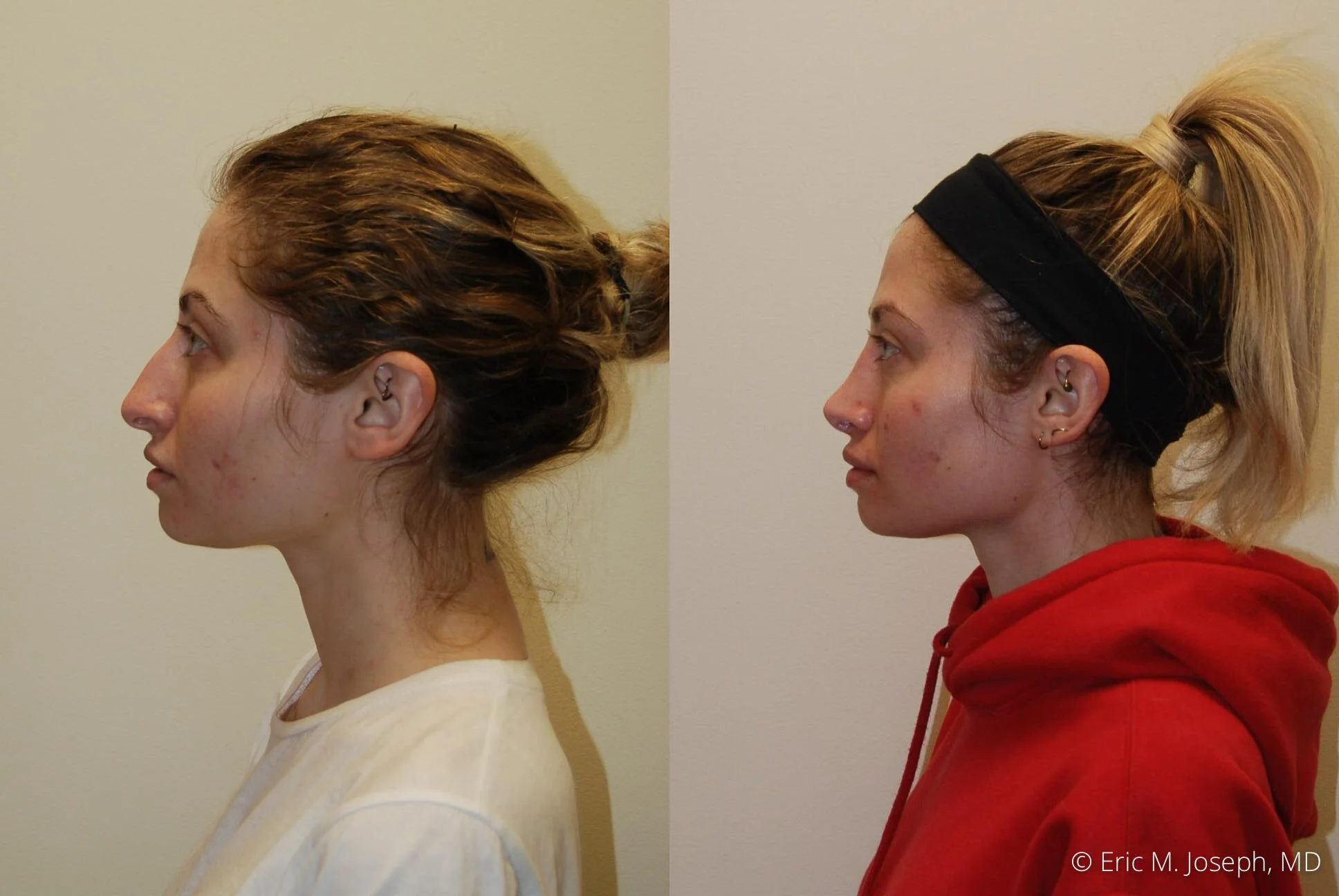 rhinoplasty-new-jersey-essex-bergan-nj-0430.jpg