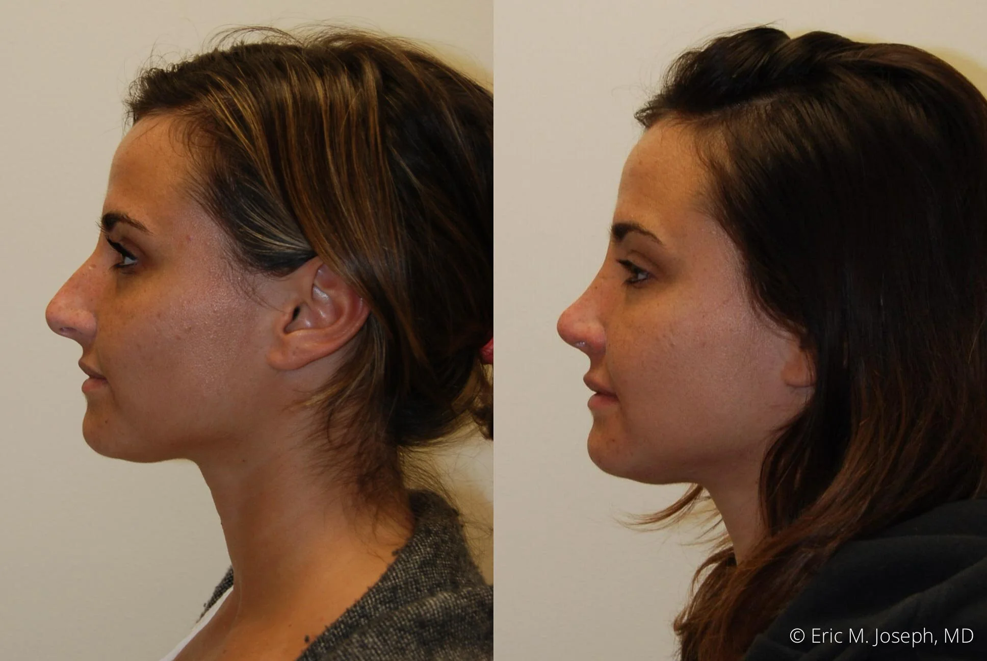 rhinoplasty-new-jersey-essex-bergan-nj-0432.jpg