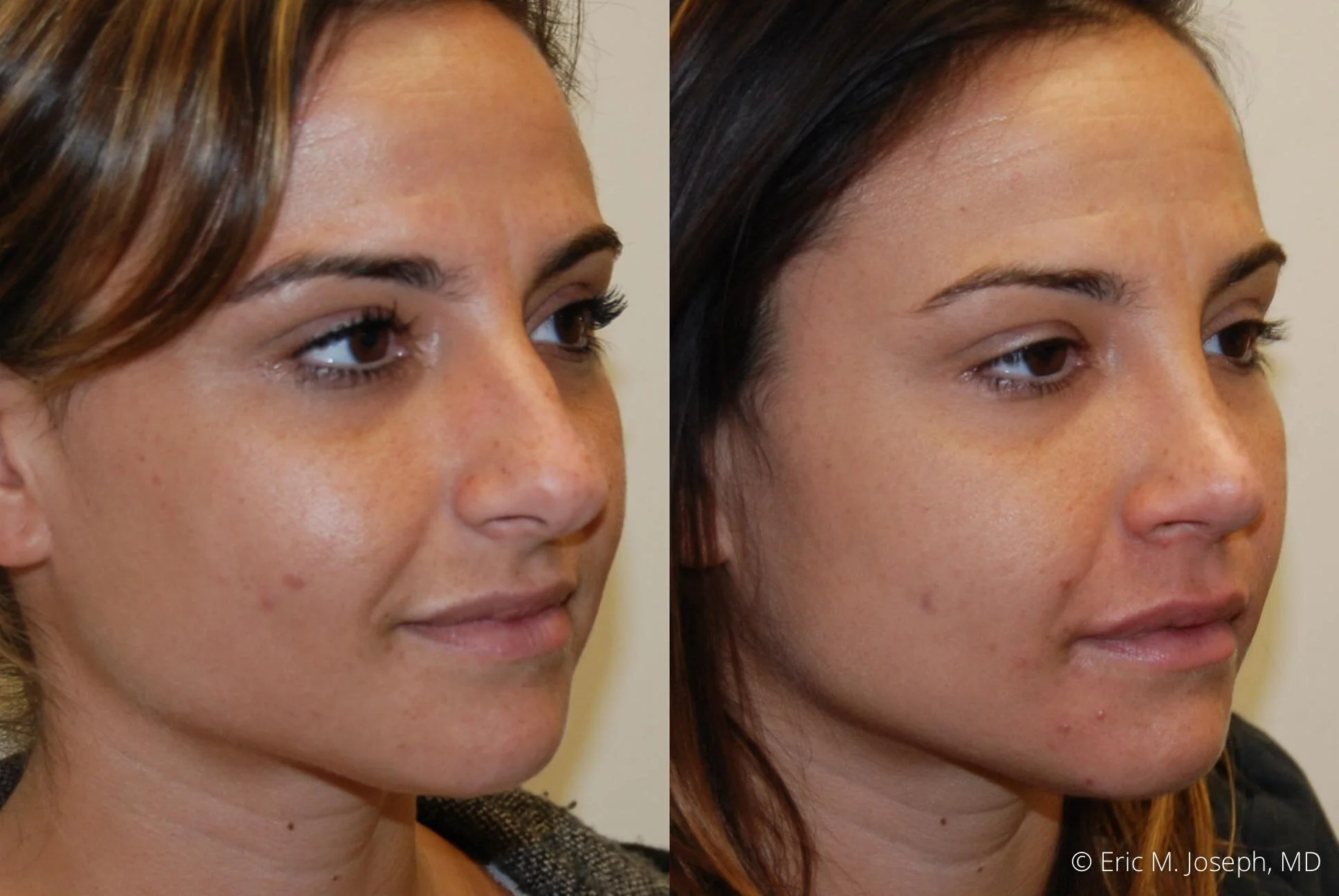 rhinoplasty-new-jersey-essex-bergan-nj-0434.jpg