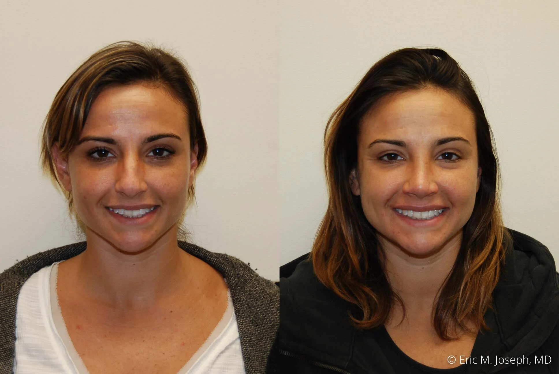 rhinoplasty-new-jersey-essex-bergan-nj-0436.jpg
