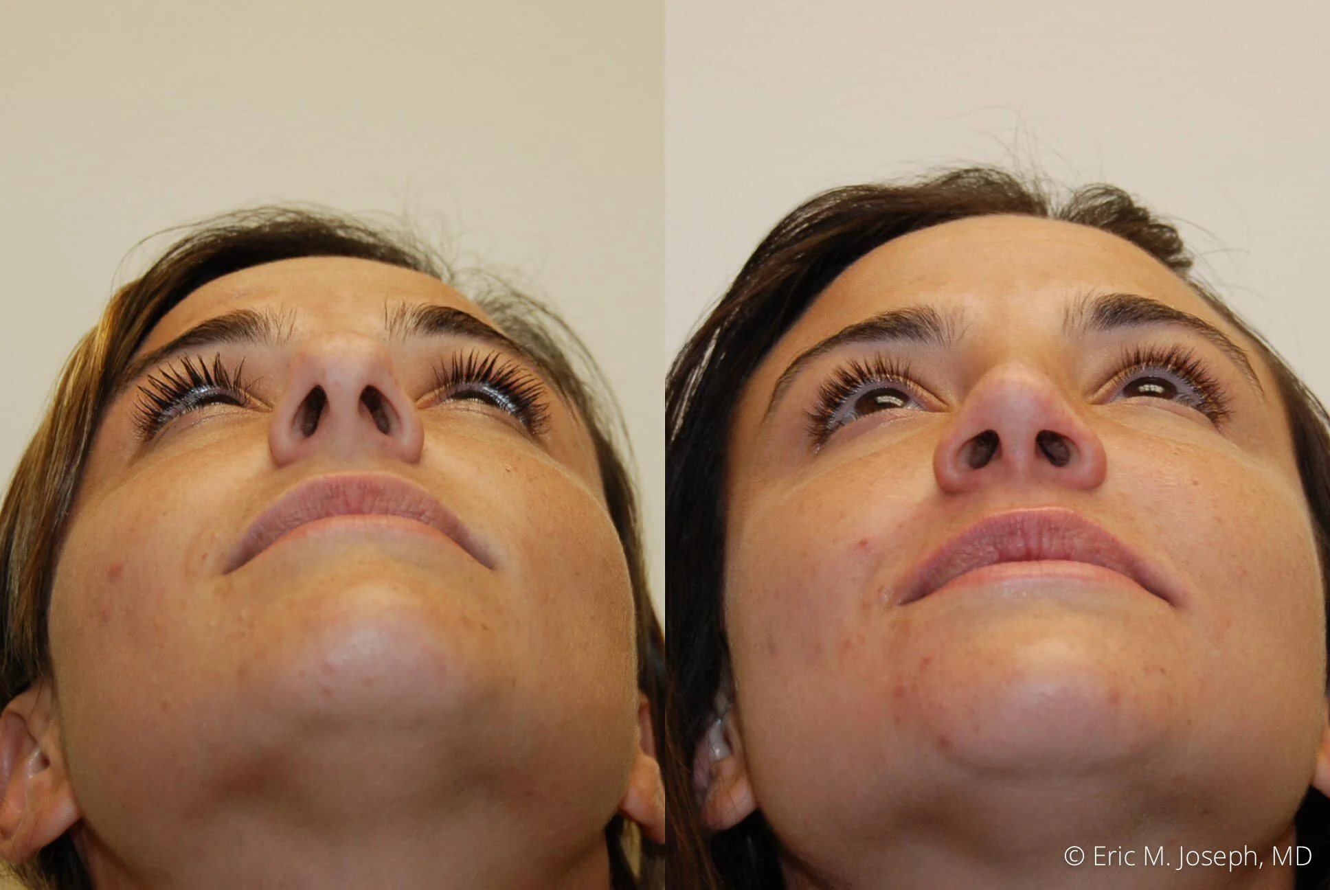 rhinoplasty-new-jersey-essex-bergan-nj-0437.jpg