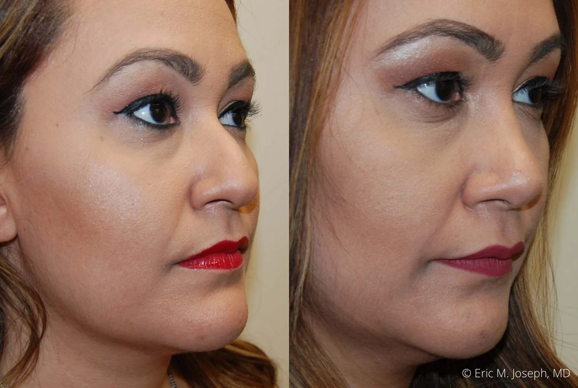 rhinoplasty-new-jersey-new-york-nj-0407.jpg