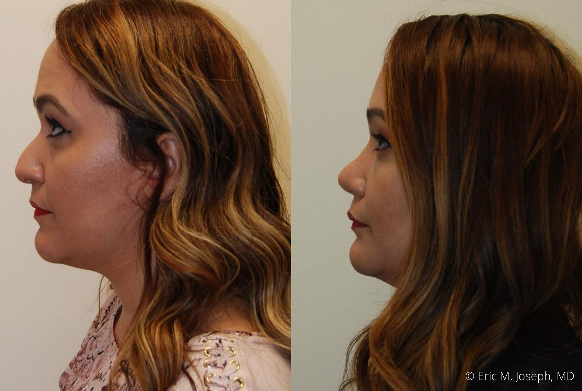 rhinoplasty-new-jersey-new-york-nj-0409.jpg