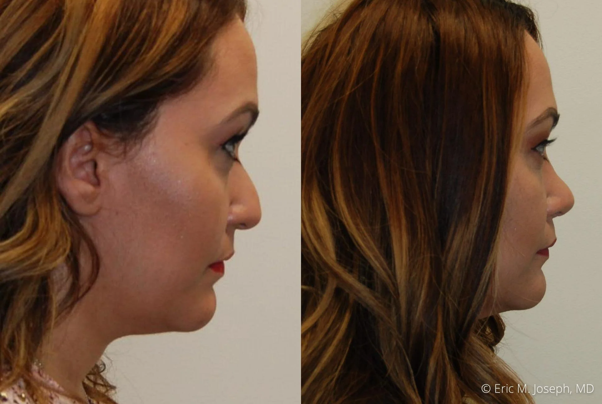 rhinoplasty-new-jersey-new-york-nj-0410.jpg