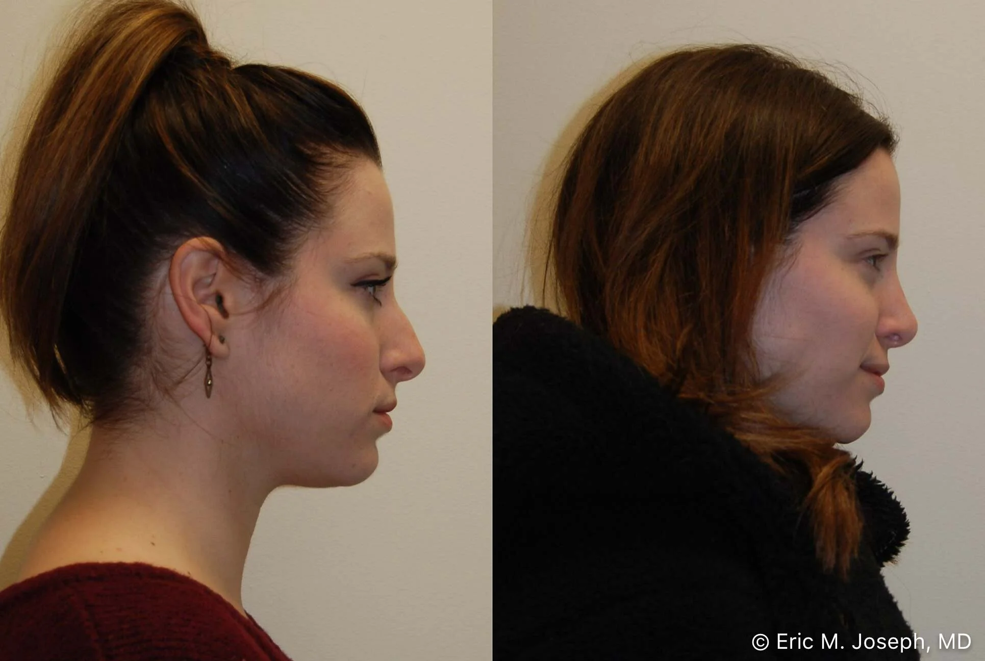 rhinoplasty-new-jersey-nyc-0529.jpg