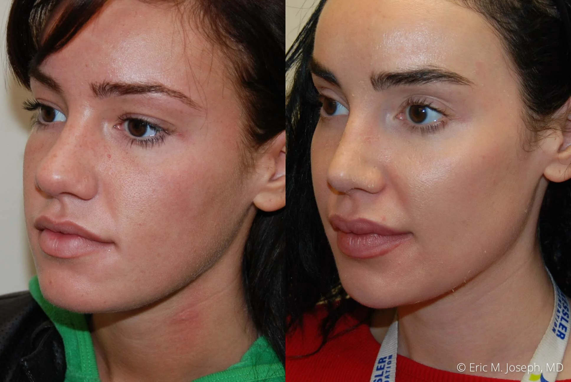 nose-job-rhinoplasty-nj-nyc-best-0456.jpg