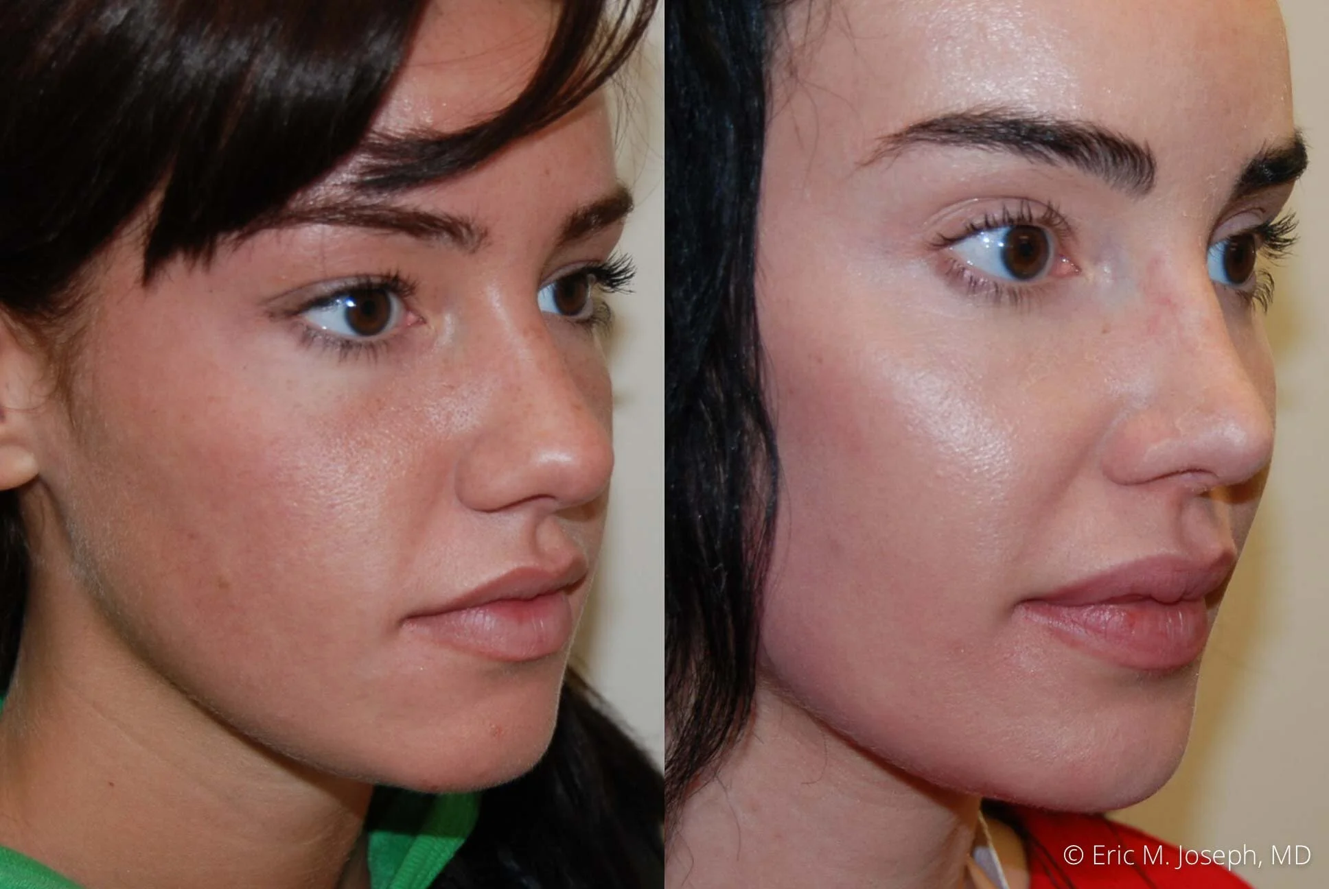 nose-job-rhinoplasty-nj-nyc-0457.jpg