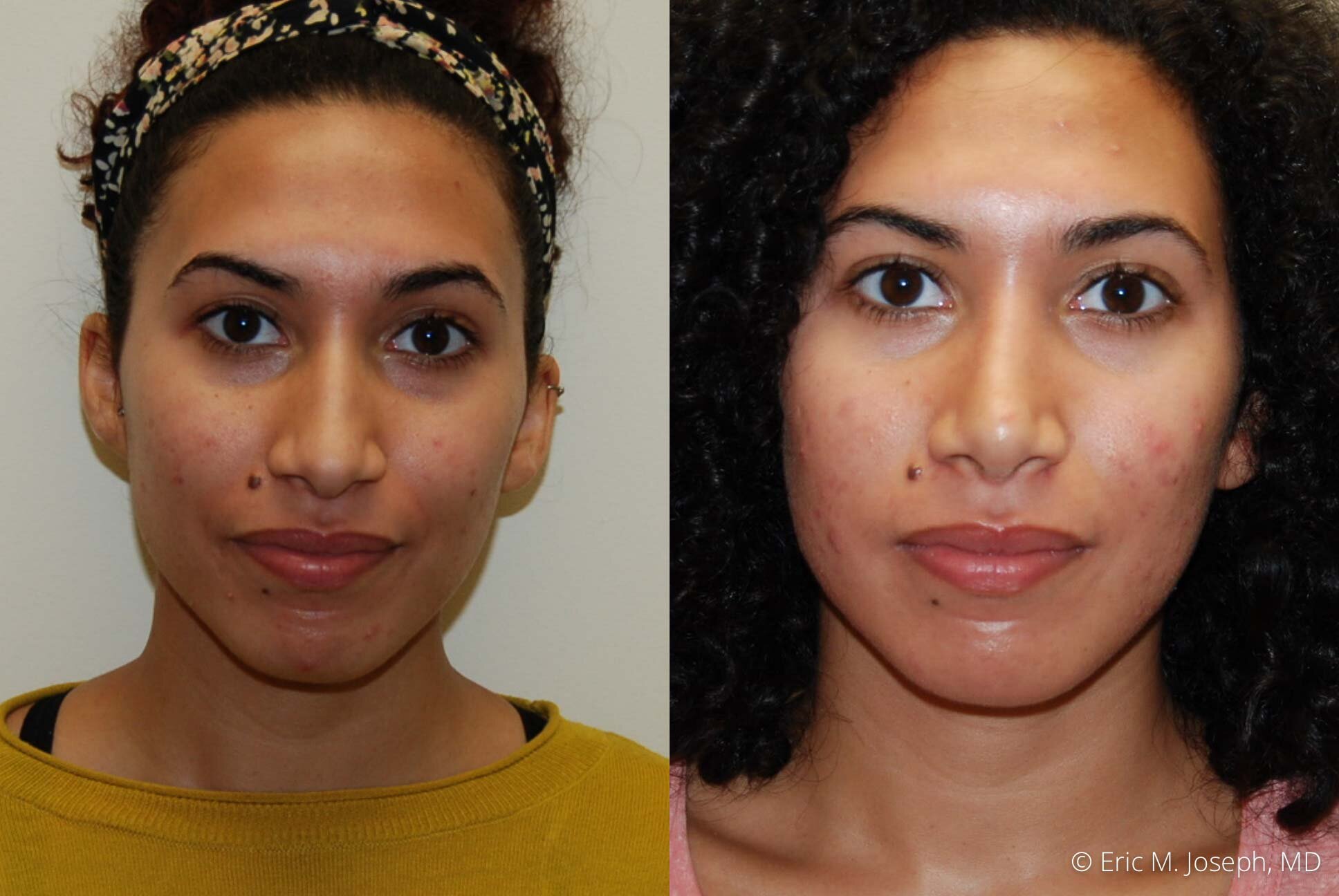 Rhinoplasty-nj-0372.jpg