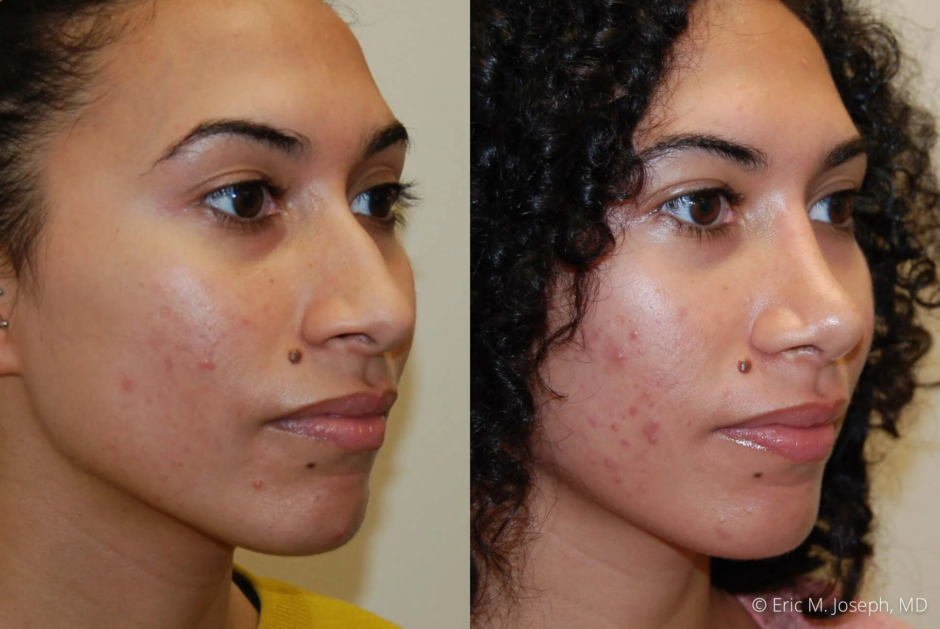 Rhinoplasty-nj-0374.jpg