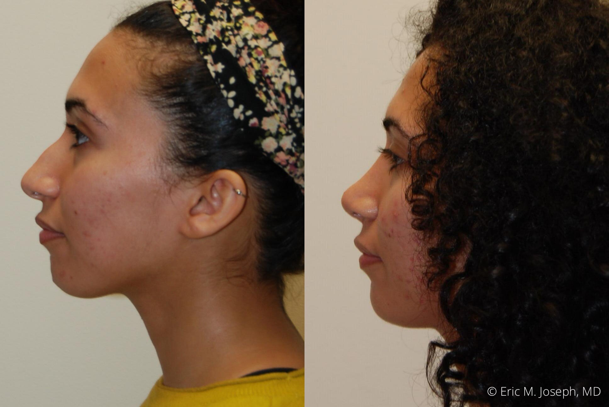 Rhinoplasty-nj-0375.jpg