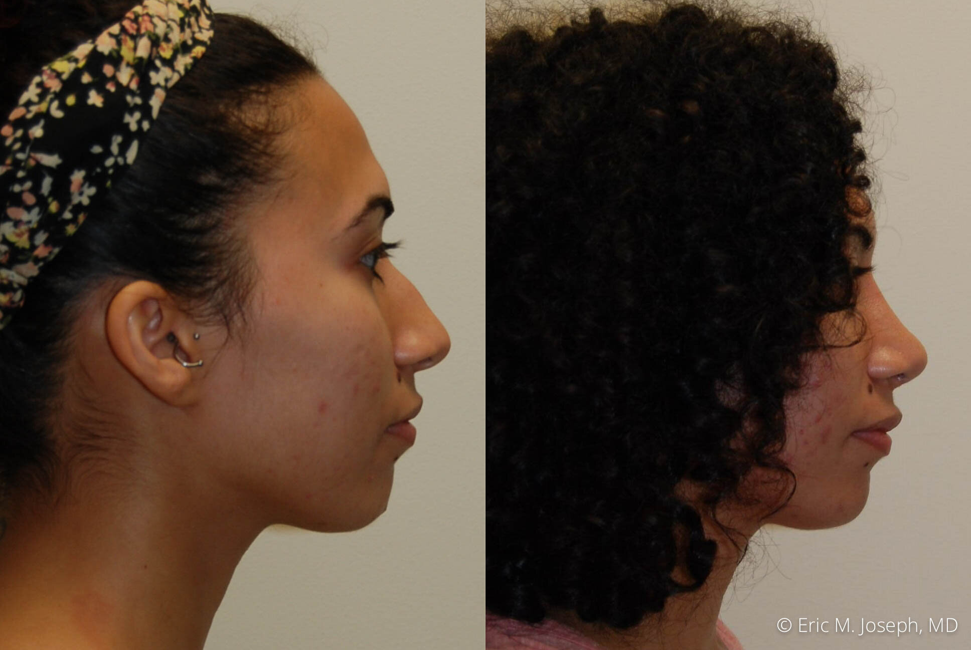 Rhinoplasty-nj-0376.jpg